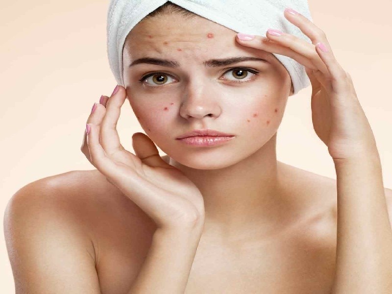 Preciso de Tratamento de Cicatriz de Acne a Laser Butantã - Tratamento de Cicatriz de Acne Hormonal