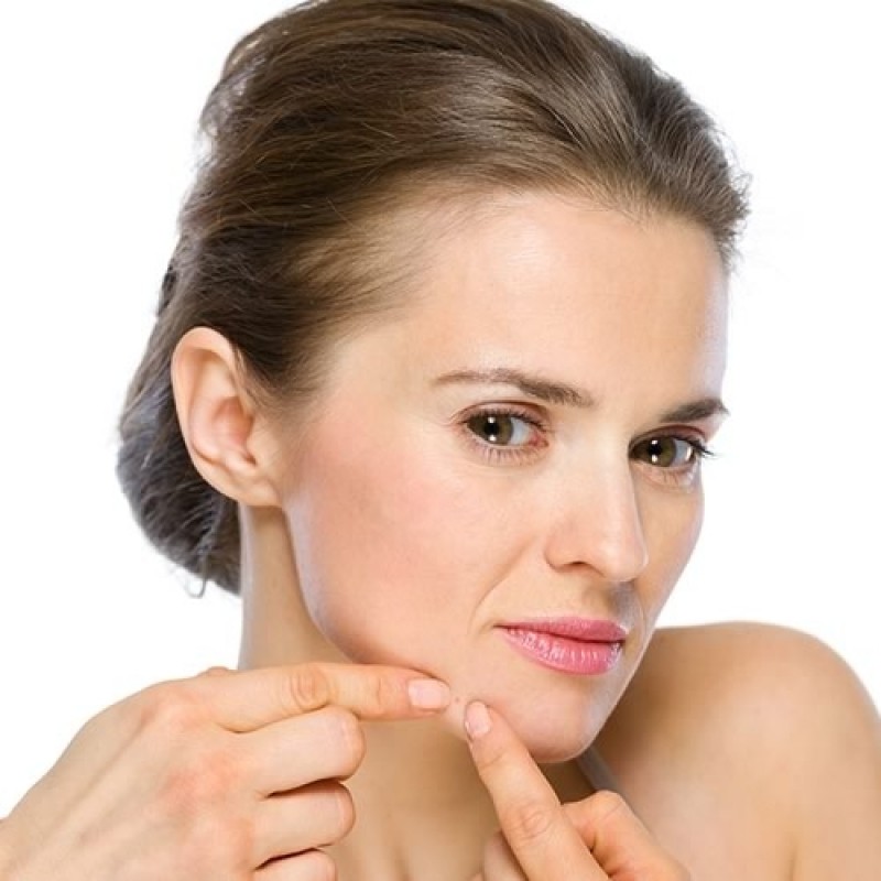 Preciso de Tratamento de Cicatriz de Acne Grave Butantã - Tratamento de Cicatriz de Acne Hormonal