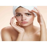 preciso de tratamento de cicatriz de acne a laser Brooklin