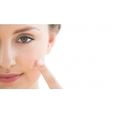 tratamento de cicatriz de acne a laser Jardins