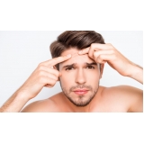 tratamento de cicatriz de acne para homens Mooca