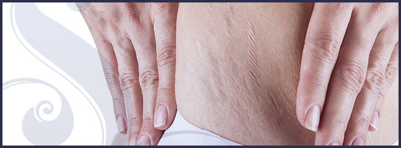 Imagem Tratamento de estrias