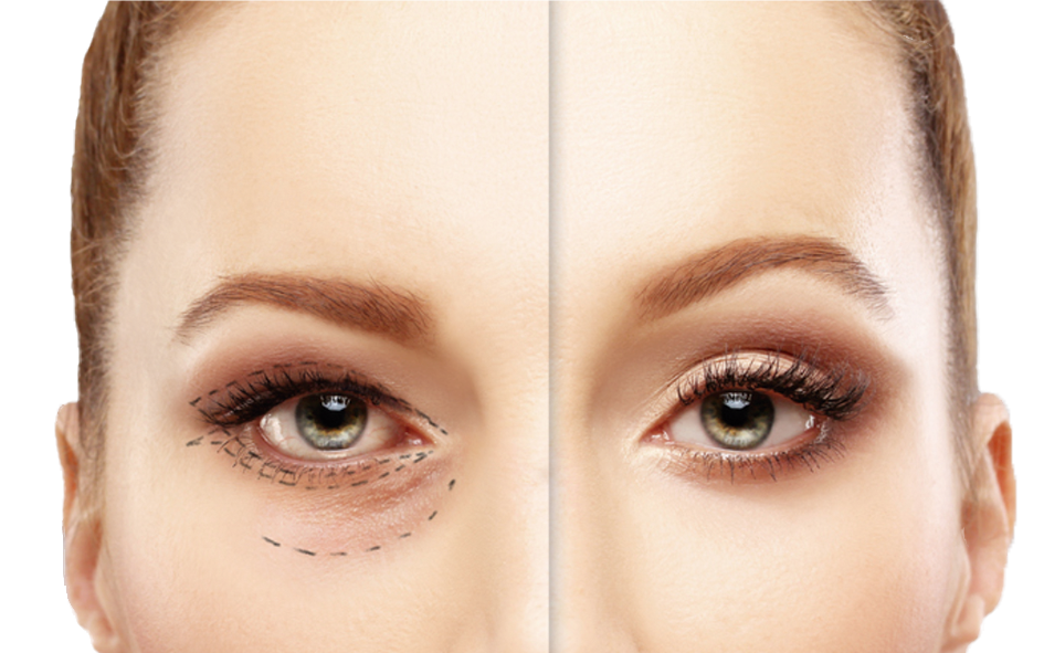 Antes e depois - Tratamentos dermatológicos para área dos olhos