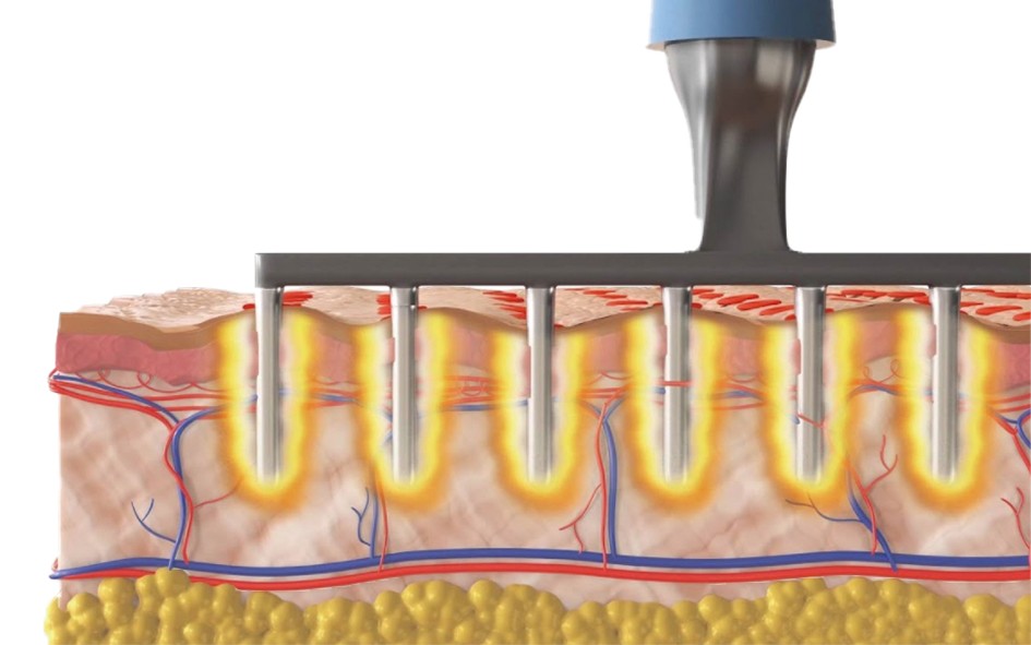 Representação da pela sob efeito de agulhas de RF para Tratamentos dermatológicos para área dos olhos