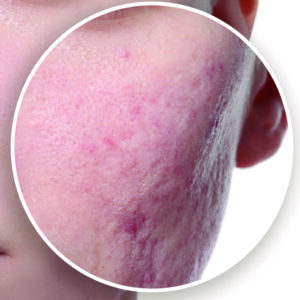 Rosto com cicatrizes de acne