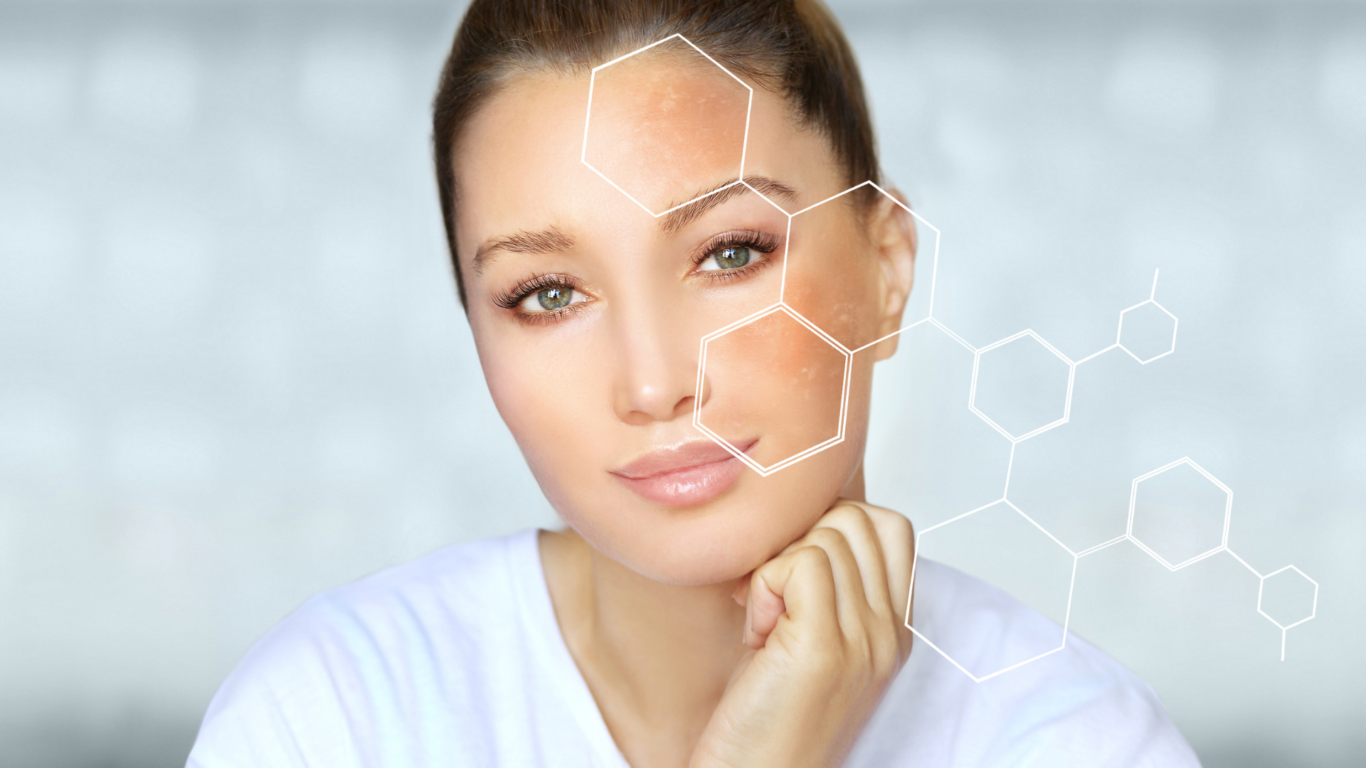 Imagem Tratamento do melasma